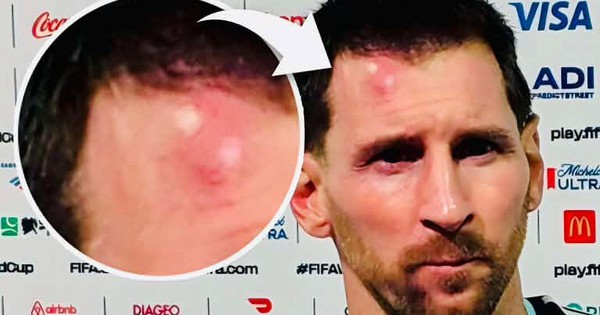 Messi sưng vêu trán sau trận thắng Cabo Verde: Vì sao nên nỗi? - hình ảnh - playgg88.vip Messi sưng vêu trán sau trận thắng Cabo Verde: Vì sao nên nỗi? - hình ảnh - playgg88.vip